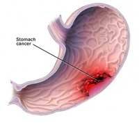 Gastric Problem Symptoms Chest Pain
