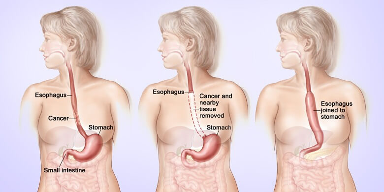 Esophagus Cancer