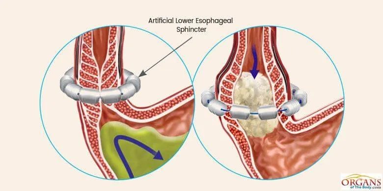 Artificial Lower Esophageal Sphincter