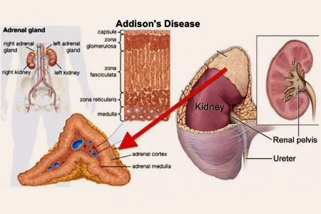 Addison Disease Causes