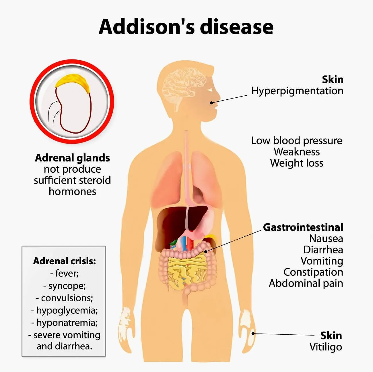 Addison's Disease