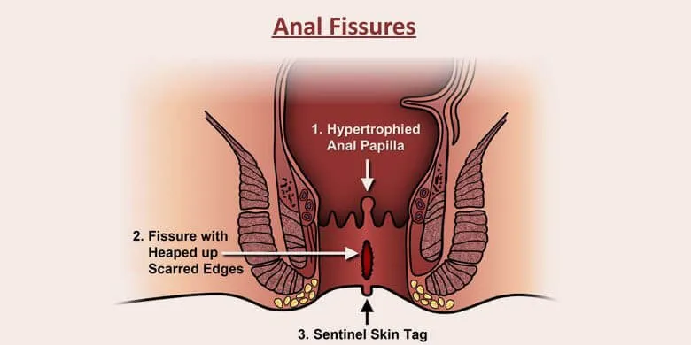 Anus Diseases - Anal Fissures