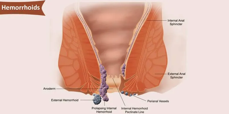 Anus Diseases - Hemorrhoids