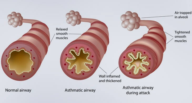 Asthma