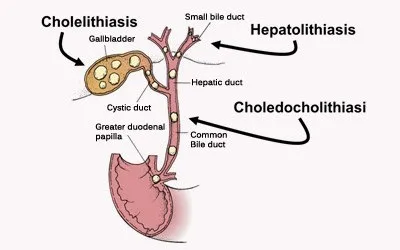 Choledocholithiasis