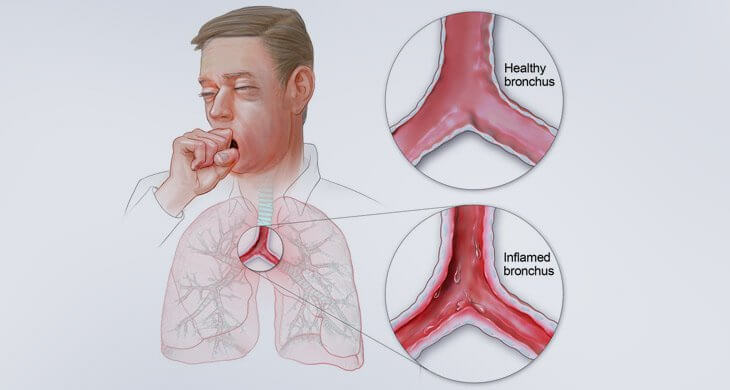 Chronic Bronchitis
