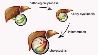 Chronic Cholecystitis