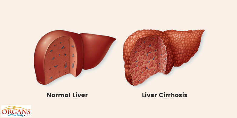 Cirrhosis