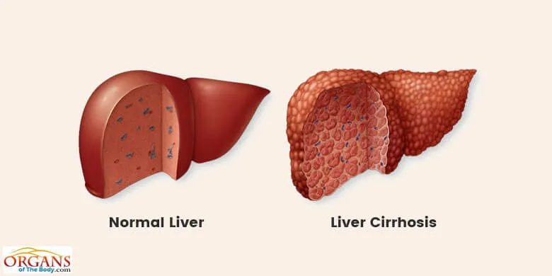 Types of Liver Diseases - Cirrhosis