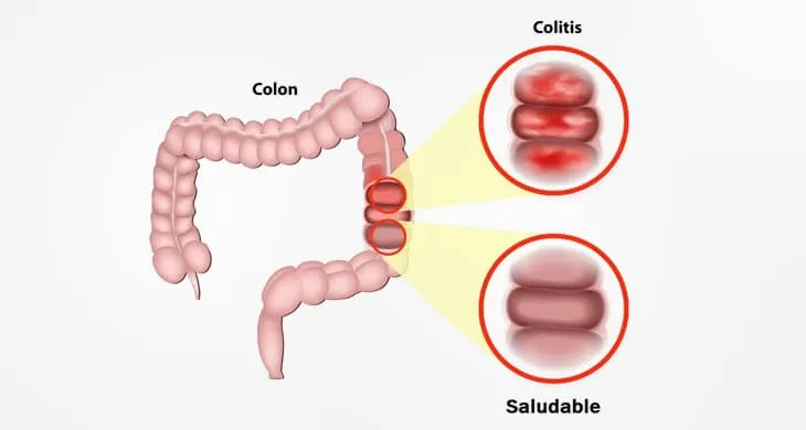 The Large Intestine - Colitis