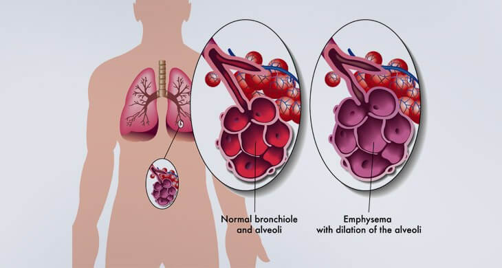 COPD