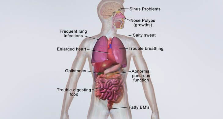 Cystic Fibrosis