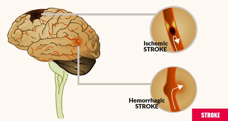 Diseases of Brain - Stroke