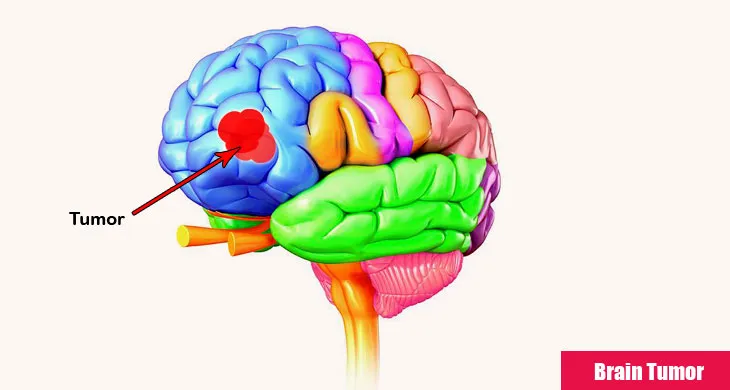 Diseases of Brain - Brain Tumor