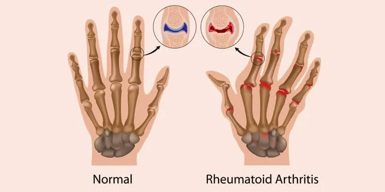 Disorders of the Hand Bones