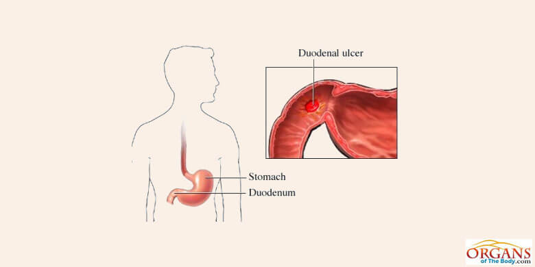 Duodenal Ulcer
