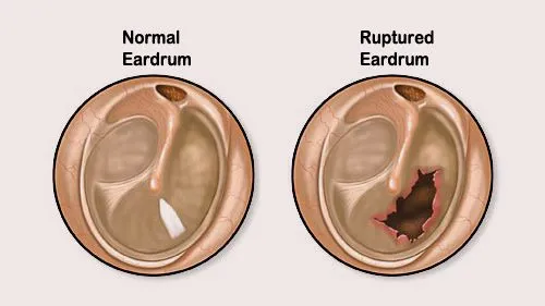 Ear Diseases - Rupture of the Eardrum