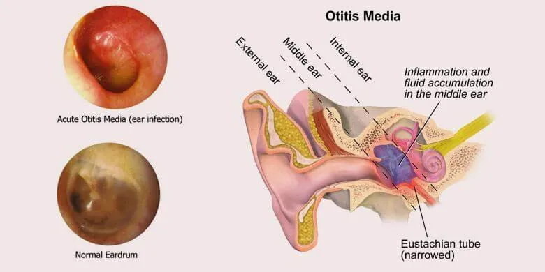 Ear Diseases - Otitis
