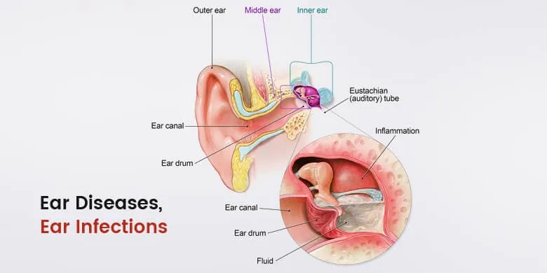 Ear Diseases, Ear Infection