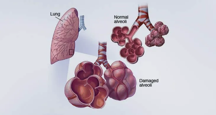 List Of Most Common Lungs Diseases In The World