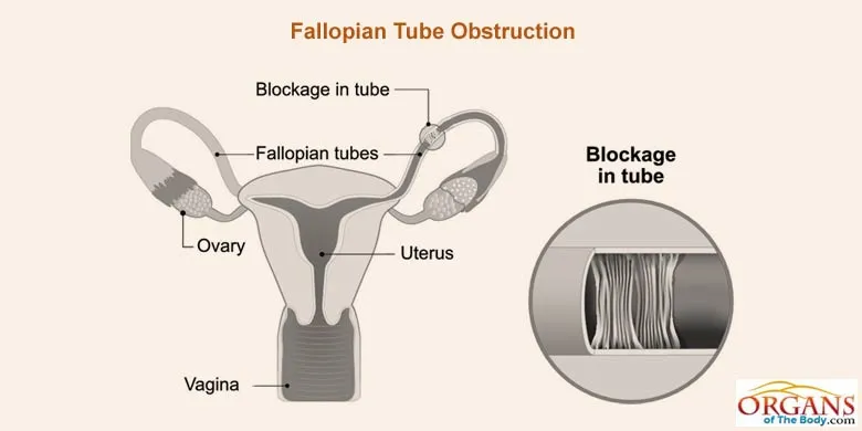 Fallopian Tube Diseases
