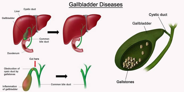 Gallbladder Disease