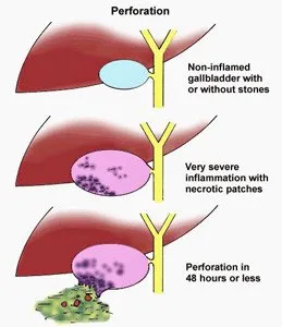 Gallbladder Perforation