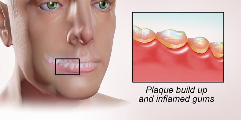 Mouth Diseases Gingivitis Picture