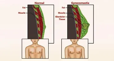 How To Get Rid of Gynecomastia?