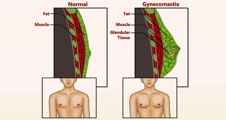 Get Rid of Gynecomastia