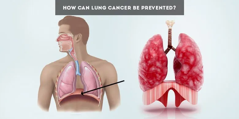 How Can Lung Cancer Be Prevented?