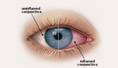 The Human Eye Problem Conjunctivitis