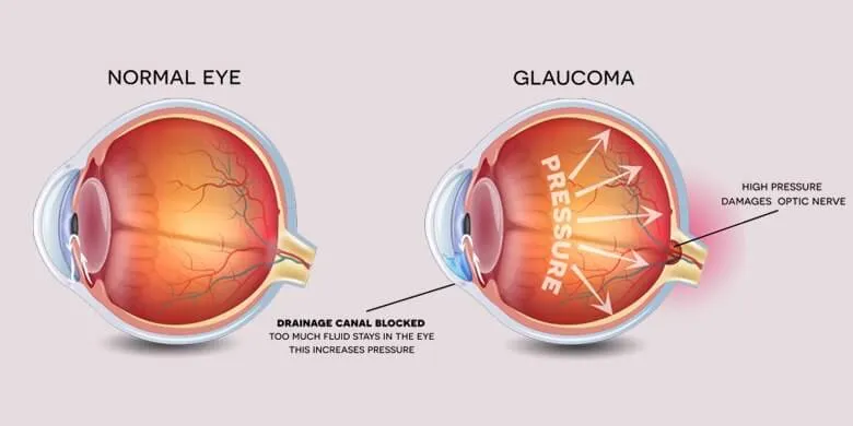 The Human Eye Problem Glaucoma