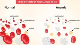 Iron Deficiency Anemia Diagnosis