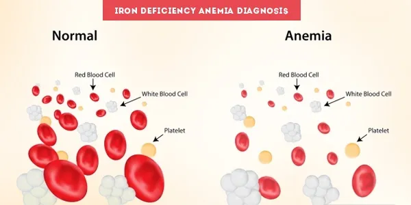 Iron Deficiency Anemia Diagnosis