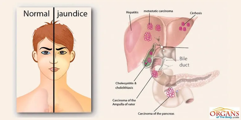 Types of Liver Diseases - Jaundice