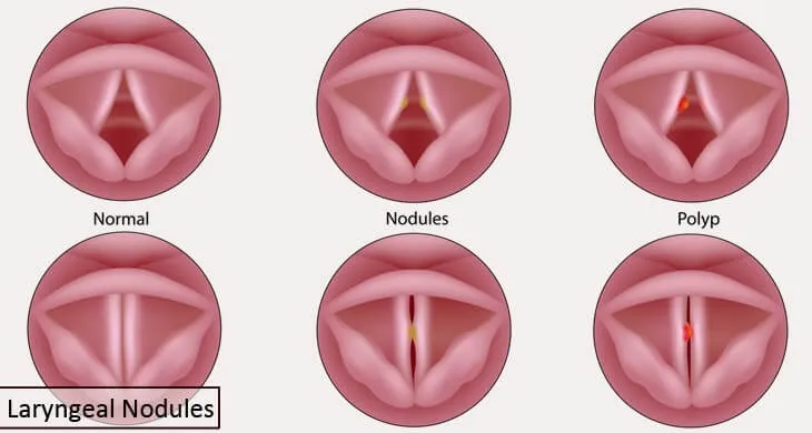 Laryngeal Nodules