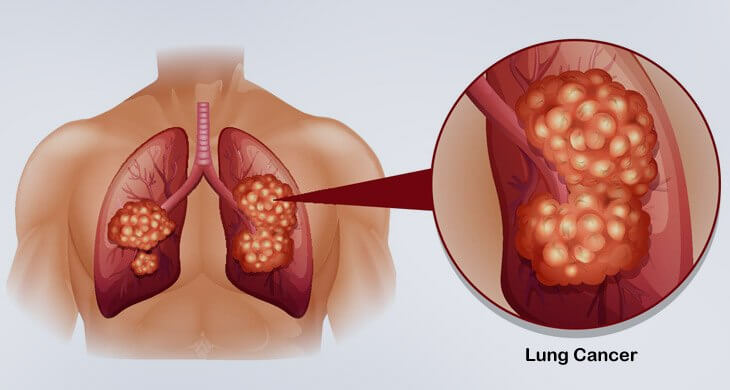 Lung Cancer
