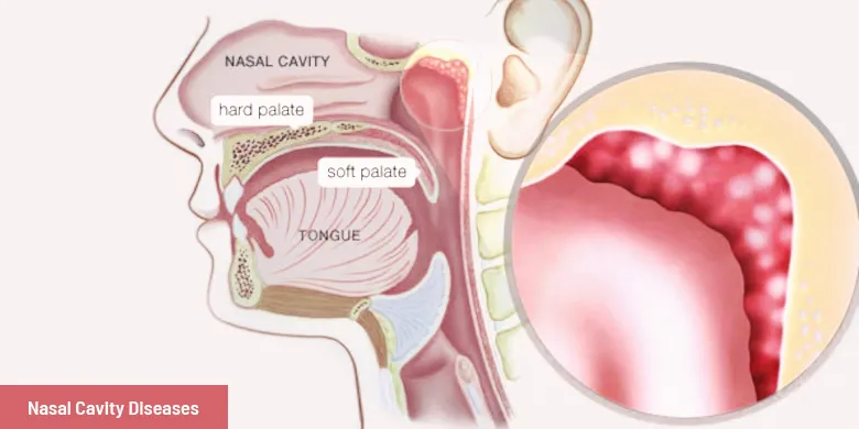 Nasal Cavity Disease