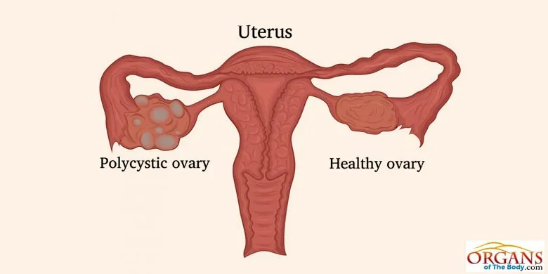 Ovaries Diseases