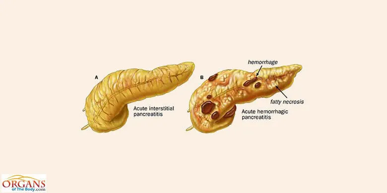 Pancreas Diseases