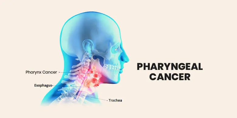 Pharyngeal Cancers