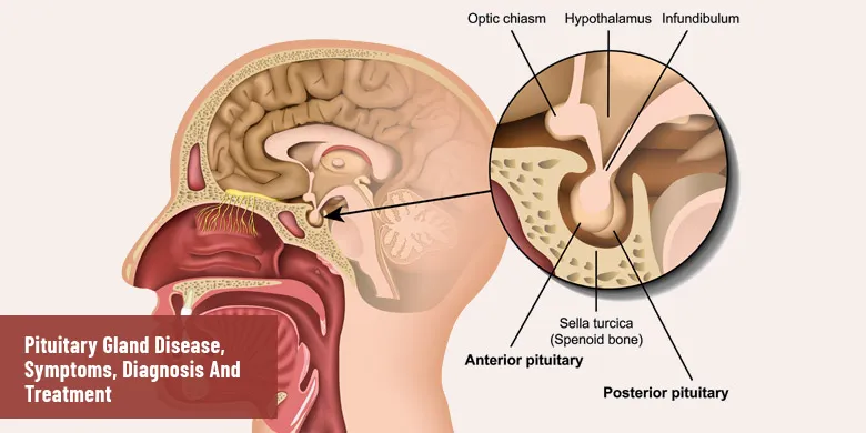 pituitary gland disease