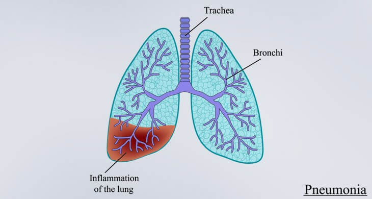 Pneumonia