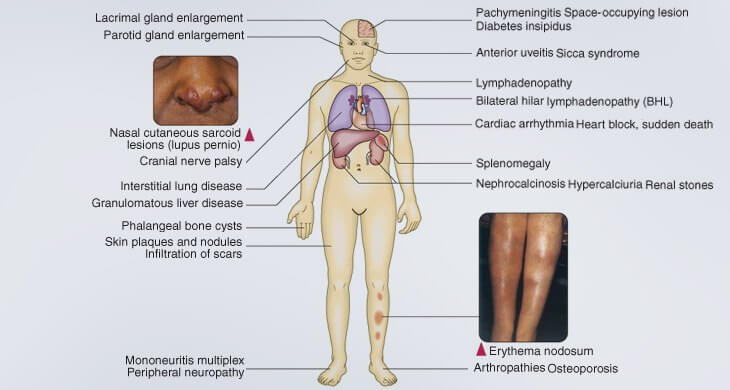 Sarcoidosis