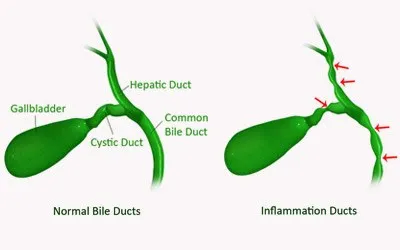 Sclerosing Cholangitis