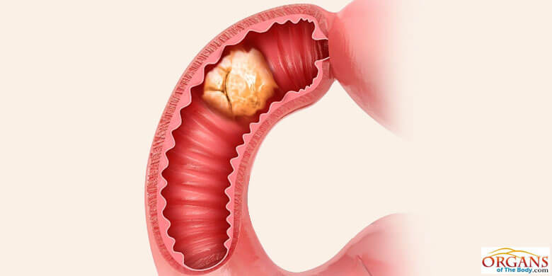 Small Intestine Cancer