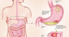 Stomach Ulcer Diet and Precautions