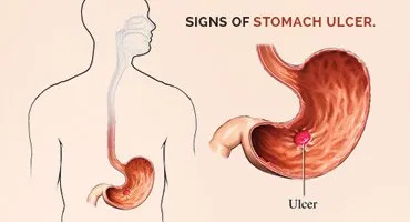Signs of Stomach Ulcer