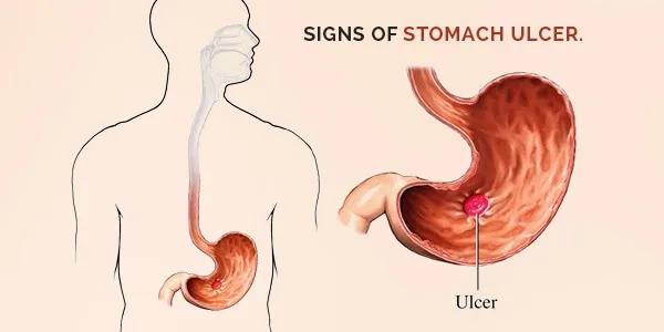 Signs Of Stomach Ulcer
